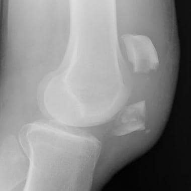 patellar dislocation xray