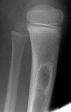 A 9-year-old boy with a simple bone cyst in the up