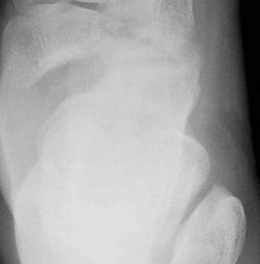 Medial fracture dislocation of the talonavicular j