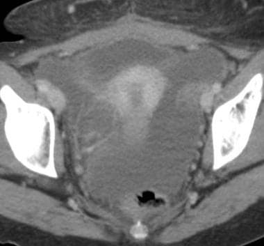 Axial and coronal CT images of a 34-year-old woman