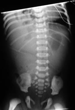 Anteroposterior (AP) view of the abdomen in a pati