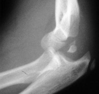 Posterolateral elbow dislocation, lateral view. In