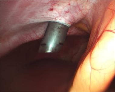 Laparoscopic cholecystectomy. Advancement of 11-mm