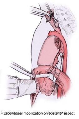 Esophageal mobilization on posterior aspect