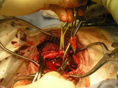 Extraction of atheromatous plaque from internal ca