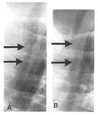 This shows the trachea during inspiration and expi