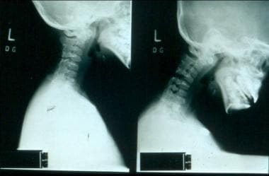 Flexion and extension views of C-spine in child wi