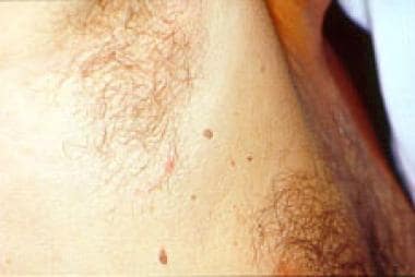 Skin Tags (Acrochordon): Causes and Treatment