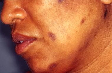 Diffuse Melanosis Cutis