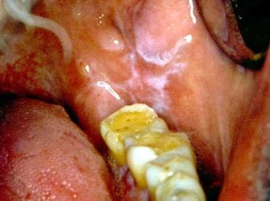 frictional keratosis cheek