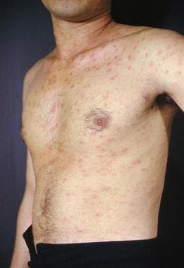 pityriasis rosea african american face