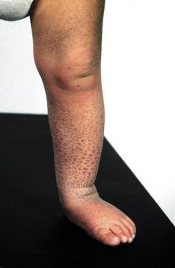 x linked ichthyosis