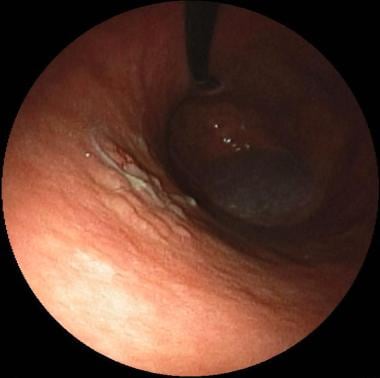 Early gastric cancer in the gastric body. Courtesy