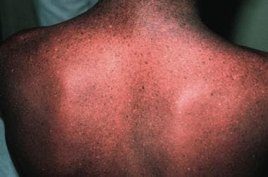 Back of an adolescent with xeroderma pigmentosum,