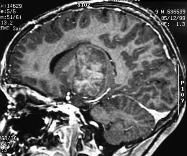 Sagittal T1-weighted MRI of the brain shows juveni