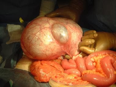 Massive mesenteric cyst that proved to be multiloc