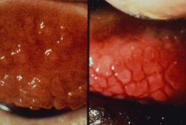 The image on the left shows intense inflammatory t