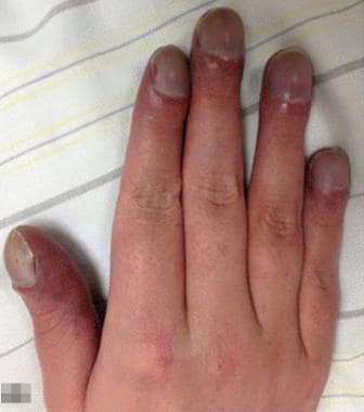 Cyanosis. Clubbed and cyanotic fingers in a patien