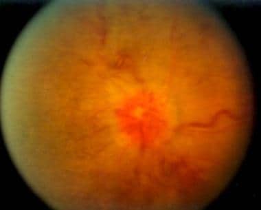 Central retinal vein occlusion showing significant