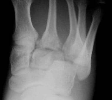 Standard anteroposterior radiograph demonstrates a