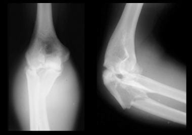 Radial head replacement, Monteggia variant and the