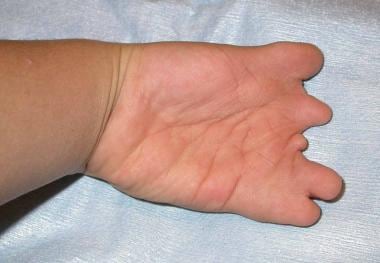 Volar view of preceding hand in patient affected w