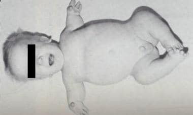 Child with diastrophic dysplasia. Note micromelic 