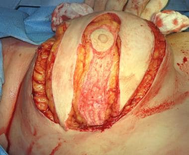 The full thickness incision is performed first aro