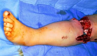 This photograph shows a complex degloving wound of