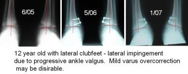 Ankle valgus is relatively common in children with