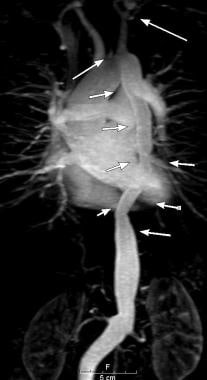Aortitis. Diffuse stenosis from the aortic arch to