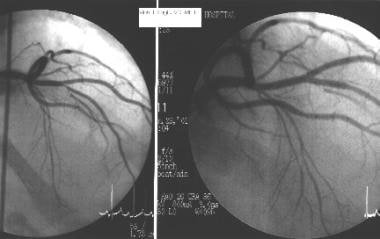 Coronary Artery Atherosclerosis. Cardiac catheteri