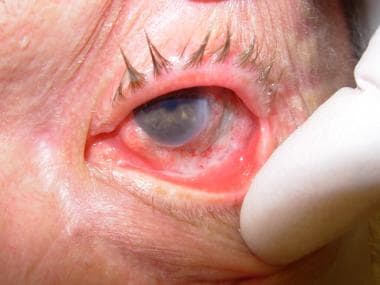 Extensive conjunctival squamous cell carcinoma of 
