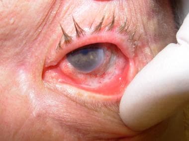 conjunctival squamous cell carcinoma