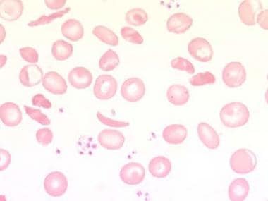 hemolytic disease of the newborn blood smear