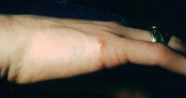 Cat Scratch Disease (Cat Scratch Fever): Background 