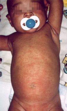 Nine-month-old infant boy presented with one-day h