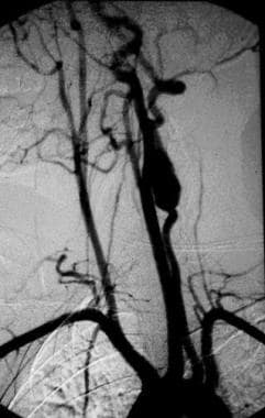 An arteriogram demonstrating aneurysmal degenerati