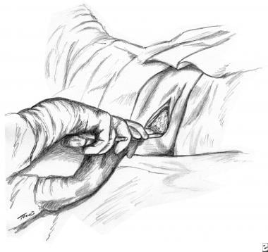 An illustration of horizontal traction with the op