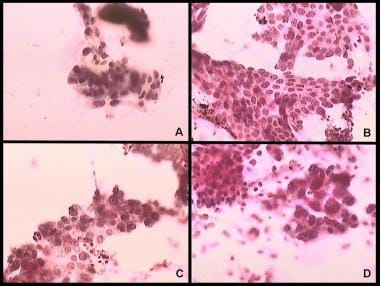 Pancreatic cancer. Cytologic samples from fine-nee
