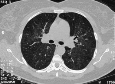 A high-resolution CT scan of the chest showing the