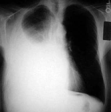 Large right-sided pleural effusion. This effusion 