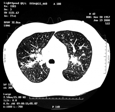 Sarcoidosis on CT scan shows nodules in midlung zo