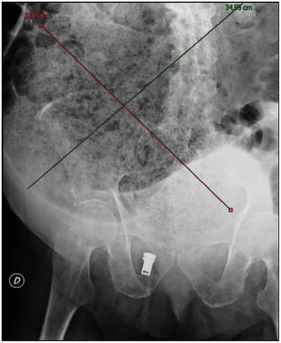 Abdominal X-ray showing fecal impaction extending 