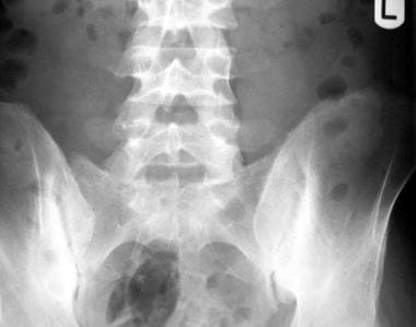 Radiography of pelvis reveals bilateral asymmetric