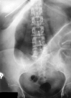 Abdominal (kidney-ureter-bladder [KUB]) radiograph