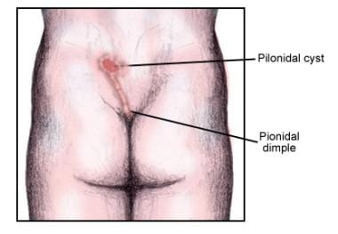 Pilonidal sinus: Symptoms, pictures, and treatment