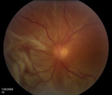 Retinal detachment. Courtesy of Kresge Eye Institu