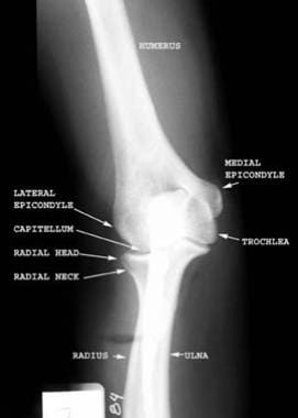 posterior elbow dislocation