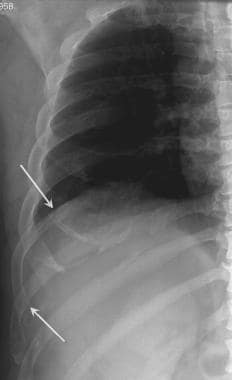 Right rib radiograph in a 48-year-old male who pre